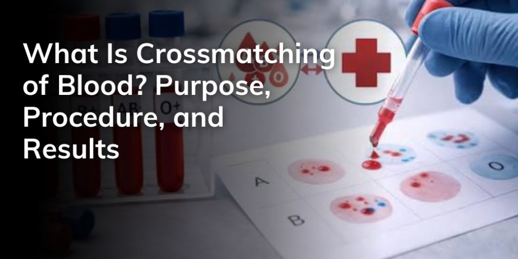What Is Cross Matching of Blood Purpose, Procedure, and Results ...